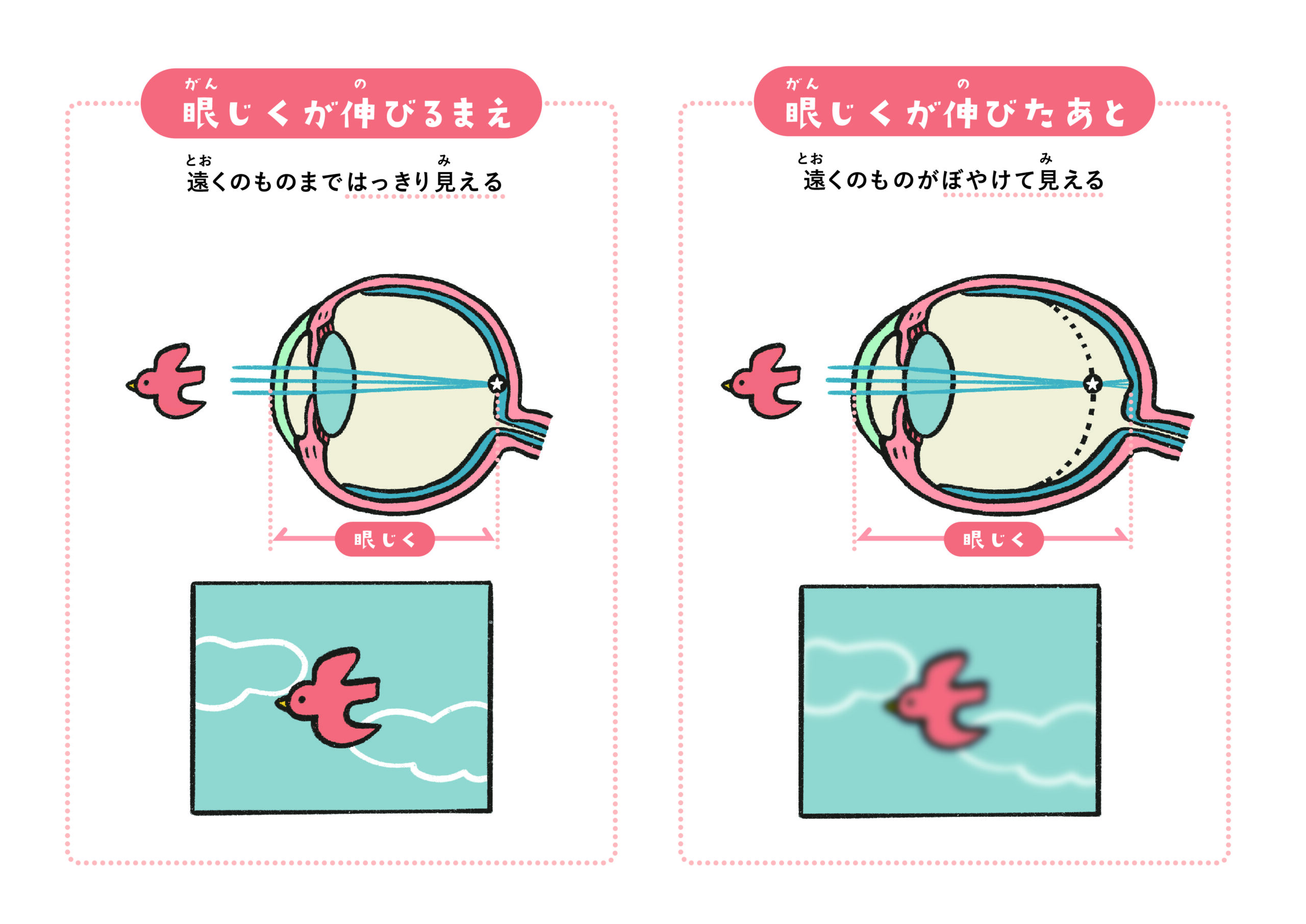 子どもの近視とその抑制の重要性について